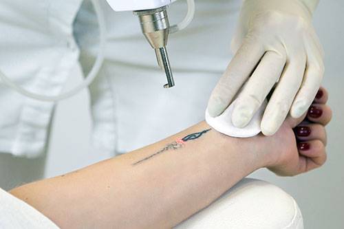 Comment effacer un tatouage au laser Paris 75002 ?