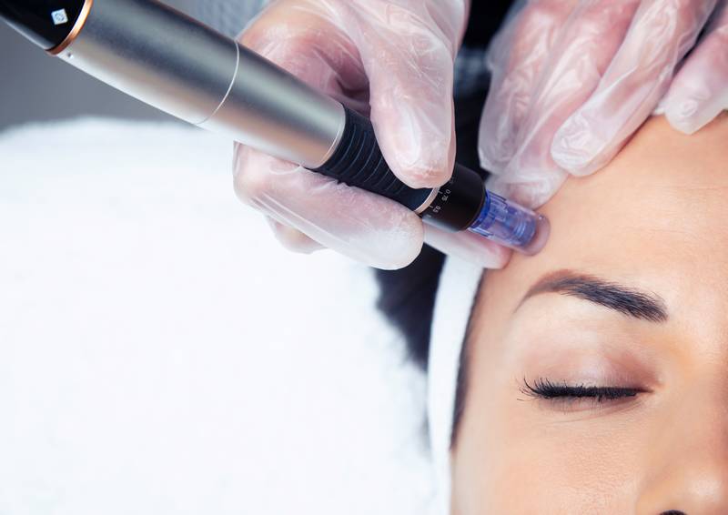 microneedling est une thérapie d'induction du collagène