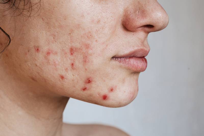 Gros plan sur la peau d'une jeune fille avec des problèmes. Les boutons, l'acné, les pores, les cicatrices. Cabinet du Docteur Dominique DENJEAN à PARIS 2
